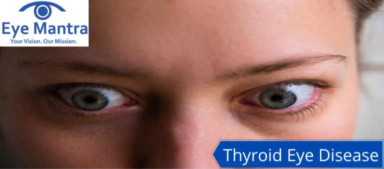 Thyroid Eye Disease