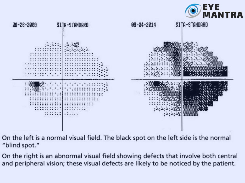 visual field test