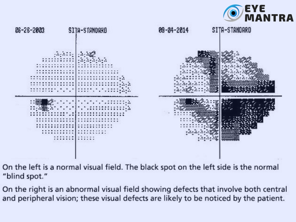 Visual field tests for Uses, procedure& cost