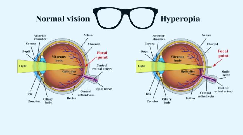 Farsightedness | Hyperopia