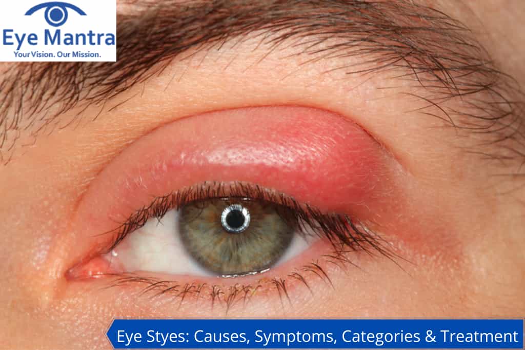 Eye Styes: Causes, Symptoms, Categories & Treatment