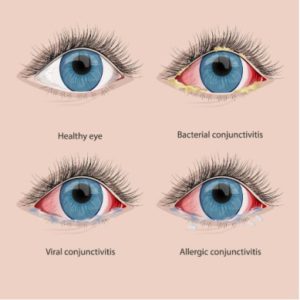 conjuctivitis