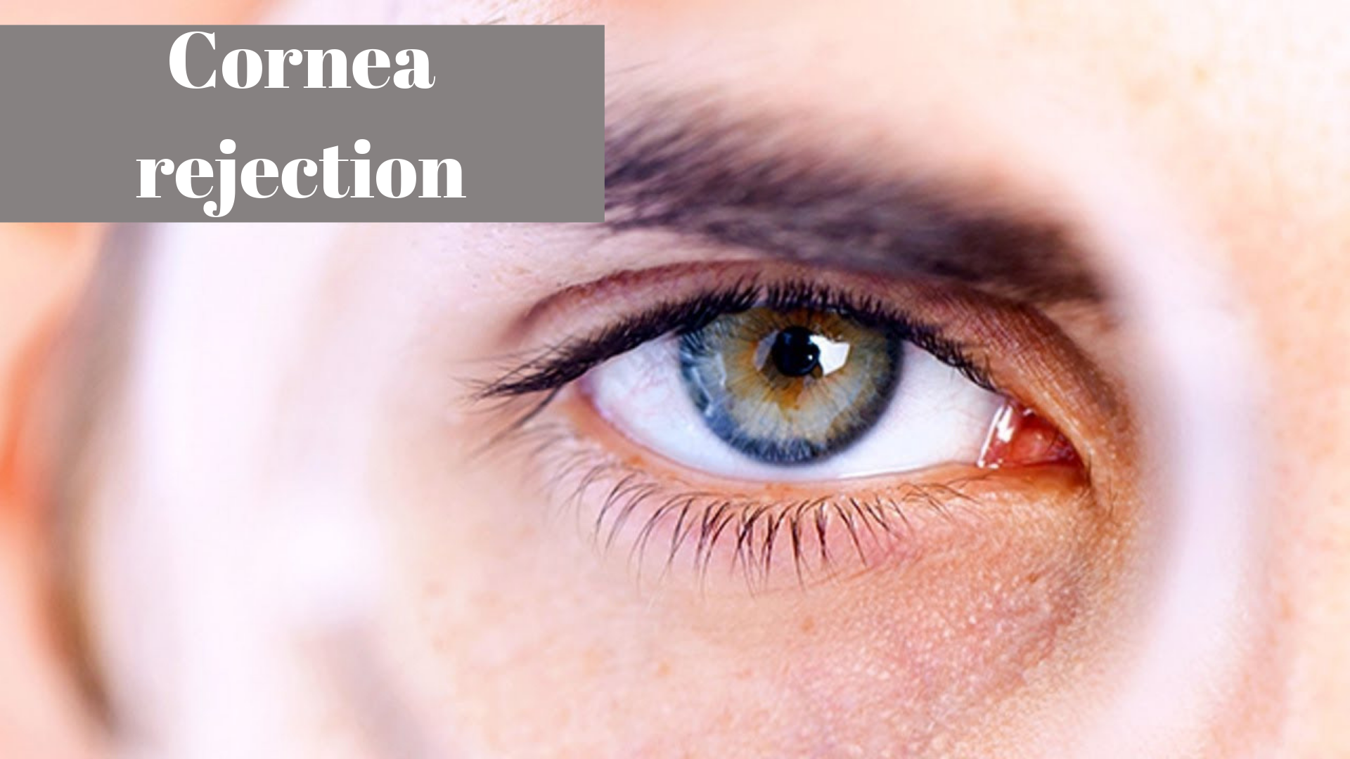 Cornea Transplant Preparation, Risk and Treatment EyeMantra