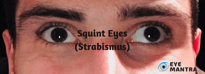 SQUINT Eyes (Strabismus)