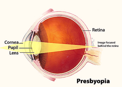 Presbyopia: Causes, Symptoms and Treatment | EyeMantra