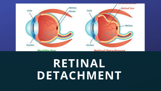 Retinal Detachment