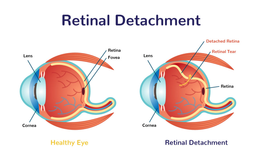 retinal detachment