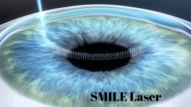 SMILE Laser Surgery