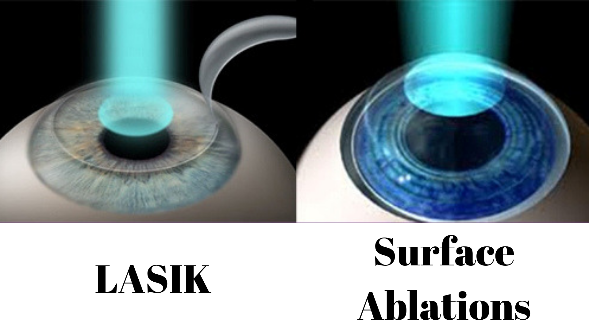 refractive surgery