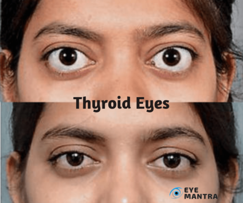 Thyroid Eye Disease