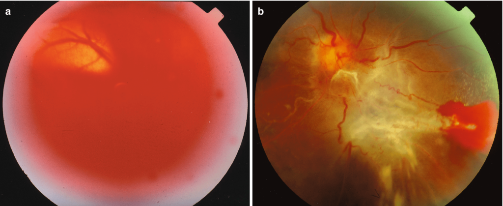 Retinal Detachment : Symptoms, Causes, and Treatment | EyeMantra