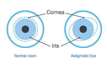 Normal vs Astigmatic Eye