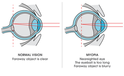 Myopia Vs Normal Vision