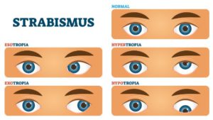 Symptoms of Strabismus