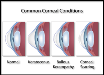 Common Corneal Conditions