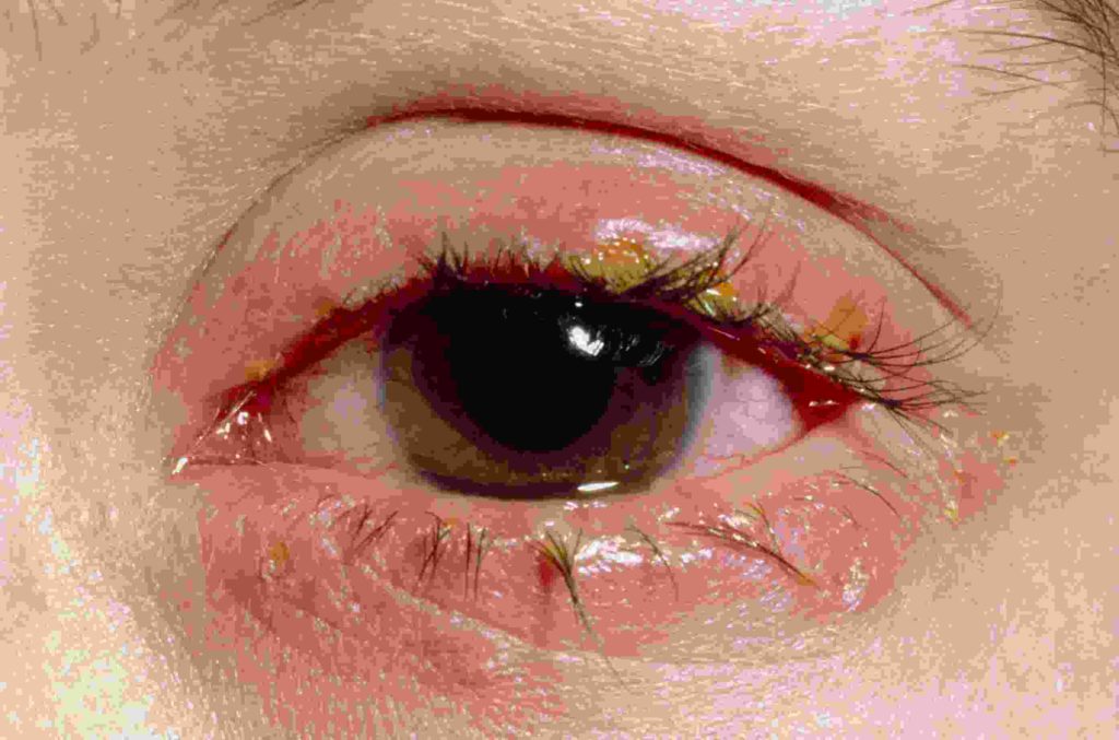 Blepharitis