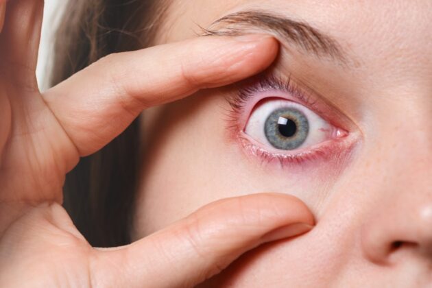 Treatment For Chalazion