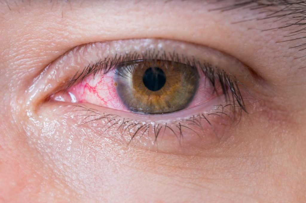 Treatment For Conjunctivitis