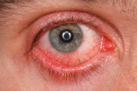 conjunctivitis