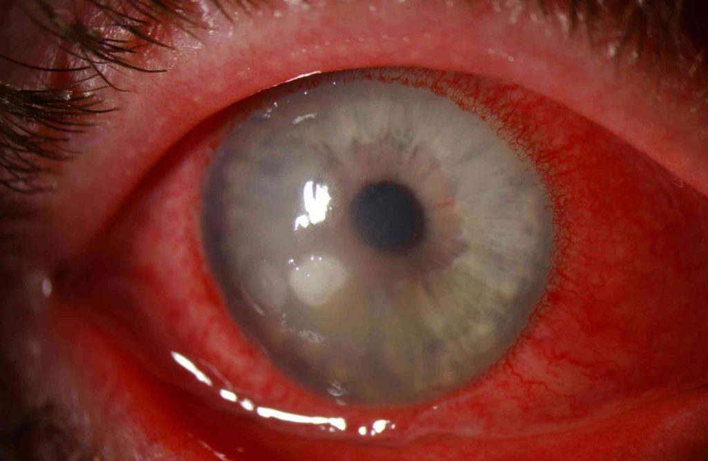 corneal ulcer