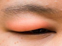 swollen-eyelid-symptoms