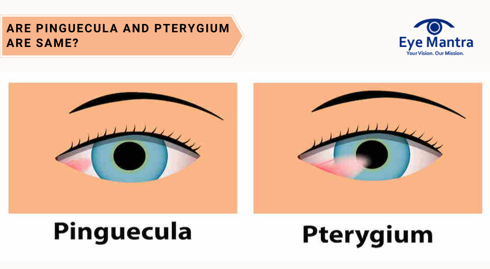 Pinguecula and Pterygium