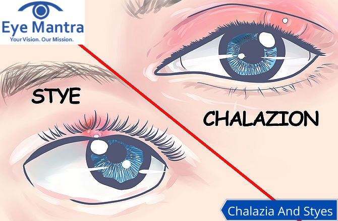 Chalazia And Styes