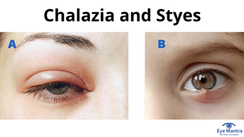 Chalazia and Styes | Symptoms & Treatment | Eye Mantra