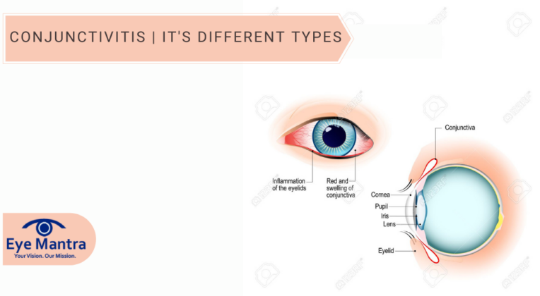 conjunctivitis