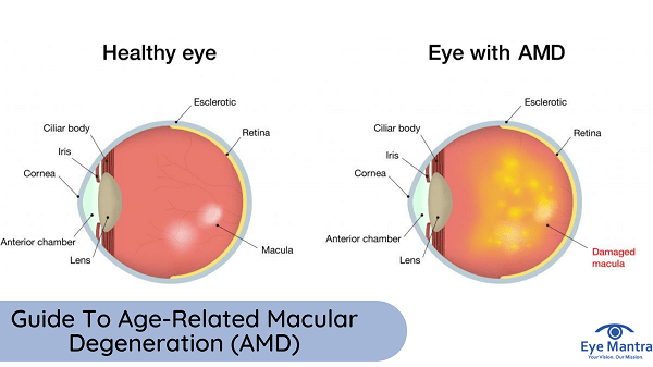 Age Related Macular Degeneration | Eye Mantra