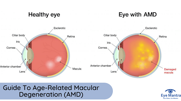 age related macular degeneration