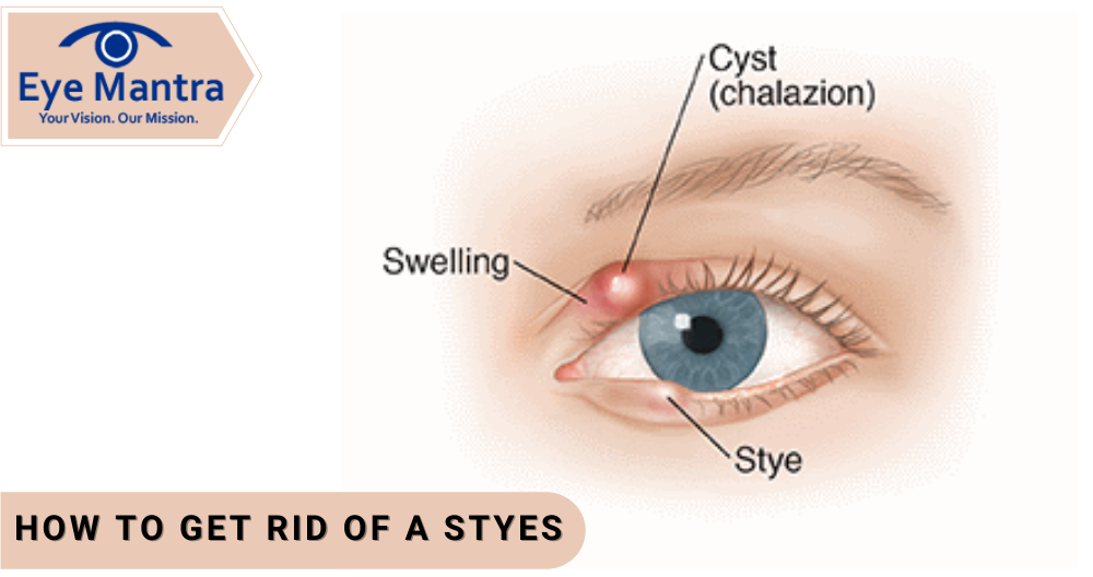 get rid of a Styes