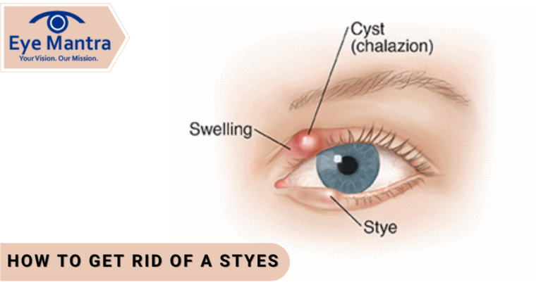 get rid of a Styes