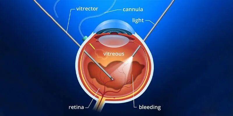 Vitreoretinal Surgery