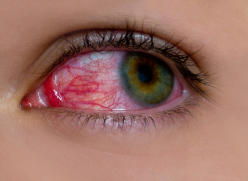 conjunctivitis