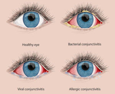 DIFFERENT KINDS OF CONJUNCTIVITIS