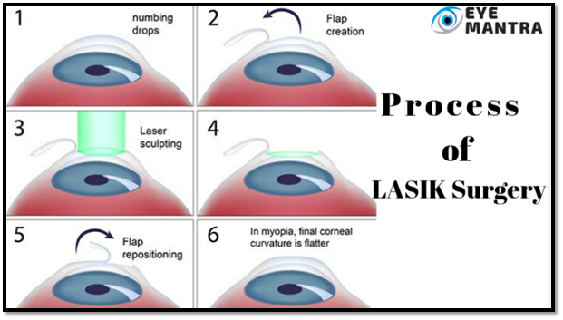 Process of Lasik Surgery