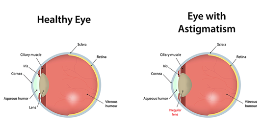 Eye With Astigmatism