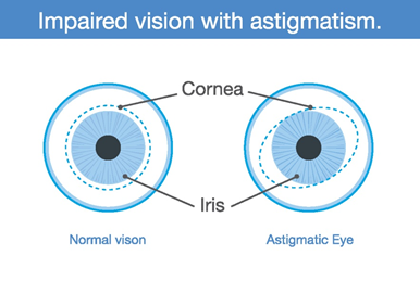 Impaired vision with Astigmatism