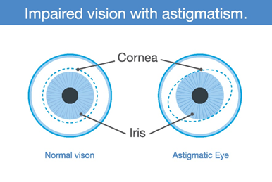 Impaired Vision With Astigmatism