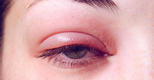 swelling-an eye injury