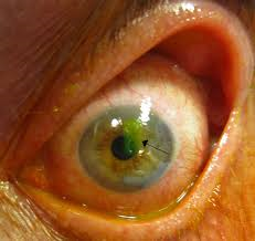 corneal abrasion