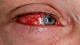 chemical burns- eye injury