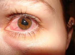 traumatic iritis- eye injury