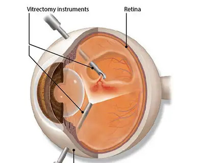 procedure of vitrectomy