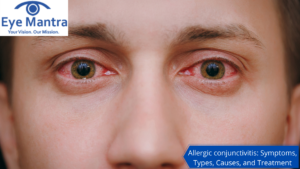 Allergic conjunctivitis Symptoms, Types, Causes, and Treatment