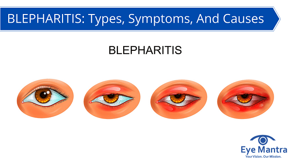 BLEPHARITIS: Types, Symptoms, And Causes | EyeMantra