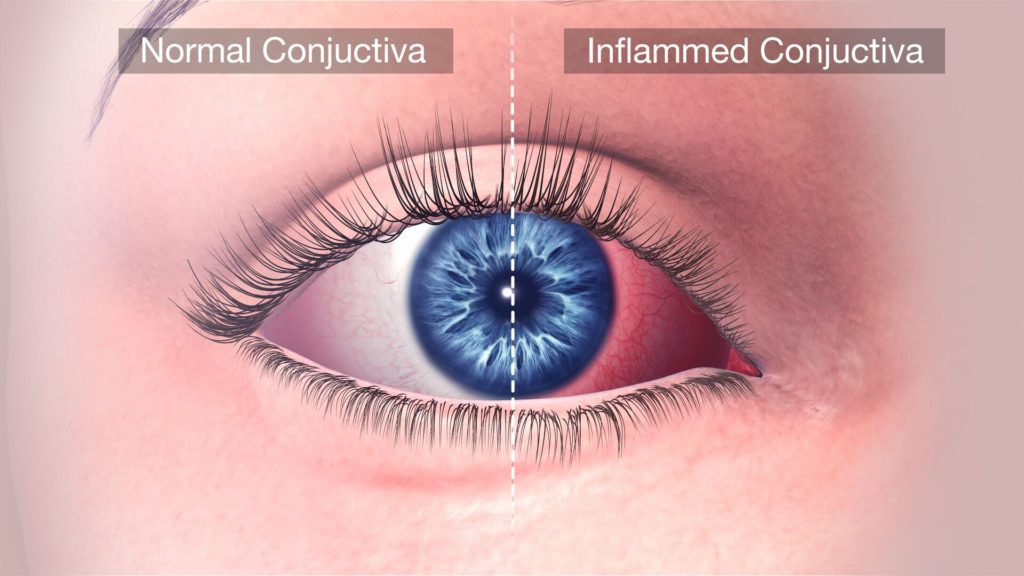 allergic conjunctivitis cold compress