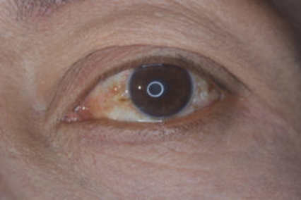 Pinguecula And Pterygium: All You Need To Know | Eyemantra Hospital