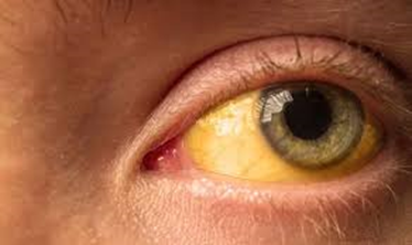 eyes yellow why eye causes treatment
